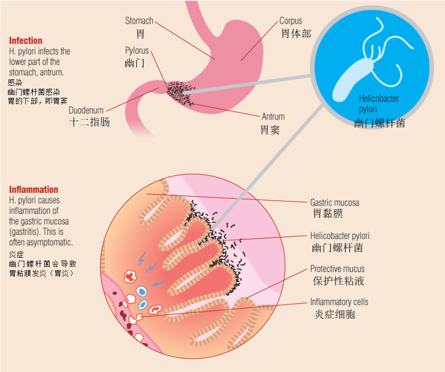 A New Option for Helicobacter pylori Removal(图4)